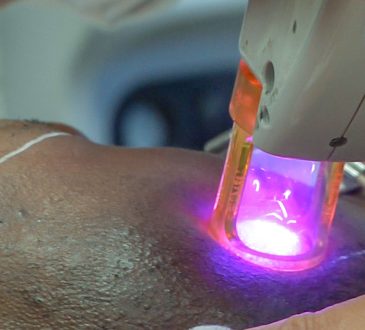 Waarom laserontharing ook voor mannen geschikt is